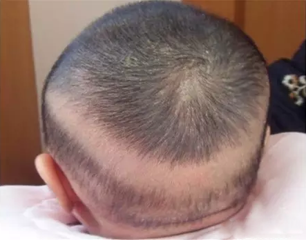 枕禿多久能長出頭發 孩子枕禿會很嚴重嗎