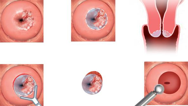 宮頸刮片和TCT篩查宮頸癌的區別是什么 宮頸刮片會引起出血嗎 宮頸刮片和TCT篩查宮頸癌的區別是什么 宮頸刮片會引起出血嗎