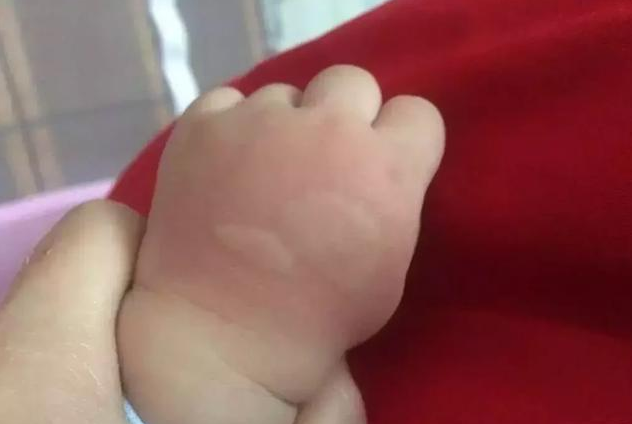 急性蕁麻疹和慢性蕁麻疹有什么區別 小兒蕁麻疹的診斷標準