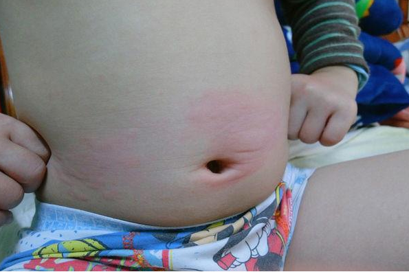 急性蕁麻疹和慢性蕁麻疹有什么區別 小兒蕁麻疹的診斷標準