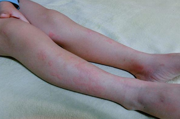 急性蕁麻疹和慢性蕁麻疹有什么區別 小兒蕁麻疹的診斷標準