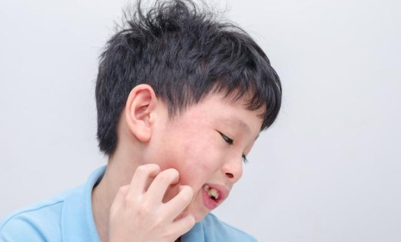 蕁麻疹能根治嗎 孩子得了蕁麻疹如何治療護理