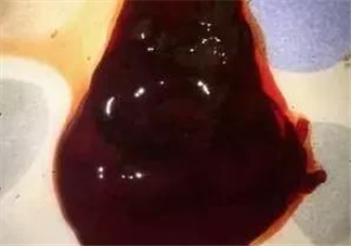 藥物流產一般需要吃什么藥物 藥物不全清宮后如何護理