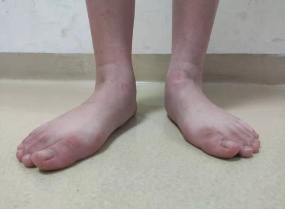 光腳走路容易得扁平足嗎 孩子扁平足產(chǎn)生的原因
