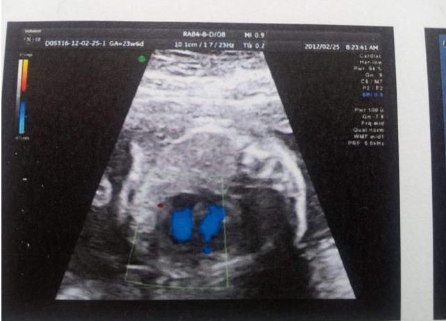 胎盤老化容易生出弱智兒嗎 孕晚期哪些孕婦容易胎盤老化