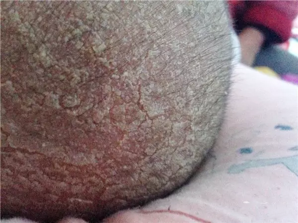 孩子頭上長乳痂是缺乏維生素B2嗎 怎么預防孩子長乳痂