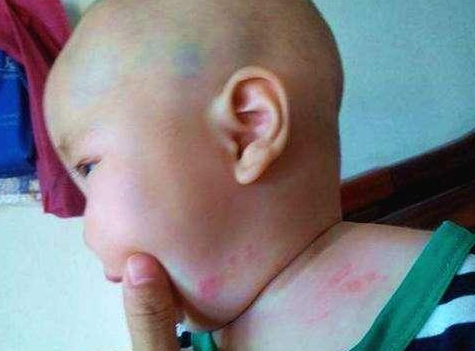 孩子被蟲咬了怎么辦 如何避免孩子被蟲咬了