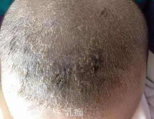 乳痂和濕疹有什么區別 乳痂和濕疹的圖片 乳痂和濕疹有什么區別 乳痂和濕疹的圖片