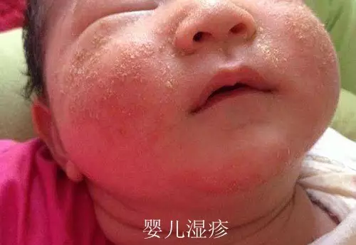 乳痂和濕疹有什么區別 乳痂和濕疹的圖片 乳痂和濕疹有什么區別 乳痂和濕疹的圖片