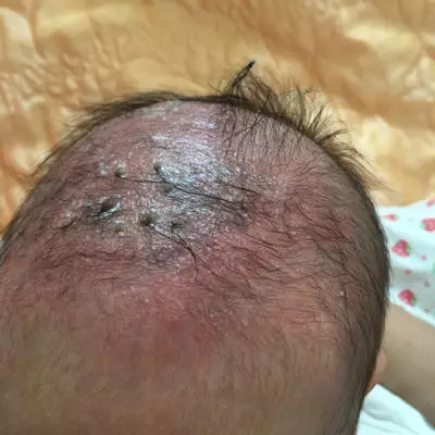 乳痂和濕疹有什么區別 乳痂和濕疹的圖片 乳痂和濕疹有什么區別 乳痂和濕疹的圖片