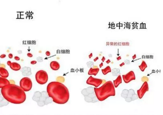 孩子有貧血怎么改善比較好 怎么緩解孩子貧血癥狀