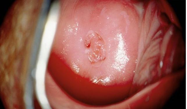 宮頸糜爛會影響受孕嗎 宮頸糜爛會對分娩造成影響嗎
