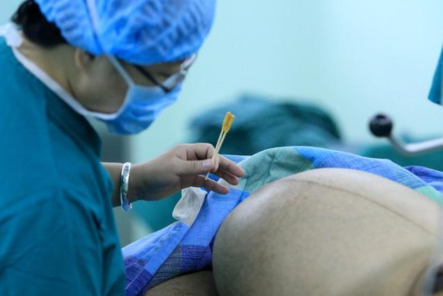 生孩子前一定要刮毛嗎 備皮的方法有哪些