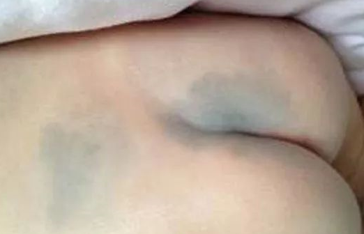 寶寶背上有青塊是怎么回事 寶寶身上的青塊多久能好 寶寶背上有青塊是怎么回事 寶寶身上的青塊多久能好