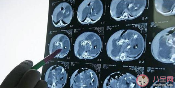 寄生胎可以存活嗎 寄生胎有沒有自己的意識