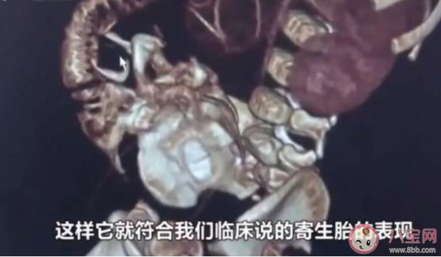 男嬰腹中藏寄生胎是怎么回事 寄生胎是怎么形成的 男嬰腹中藏寄生胎是怎么回事 寄生胎是怎么形成的