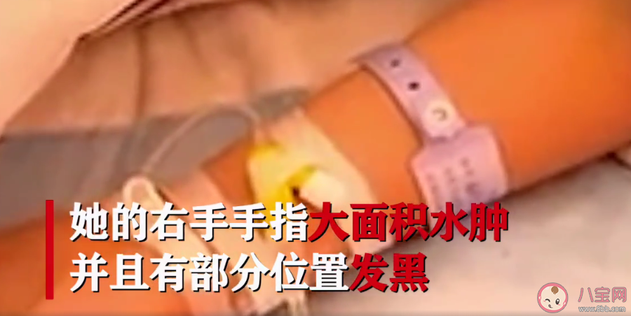 13歲女生學(xué)校掃雪3小時凍傷險遭截肢是怎么回事 冬天凍傷會有這么嚴(yán)重嗎