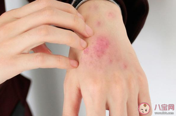 為什么會得蕁麻疹 得了蕁麻疹怎么辦