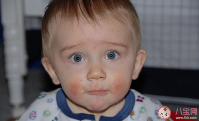 小孩發(fā)熱伴有皮疹是怎么回事 小孩發(fā)熱伴有皮疹可能是什么疾病 小孩發(fā)熱伴有皮疹是怎么回事 小孩發(fā)熱伴有皮疹可能是什么疾病