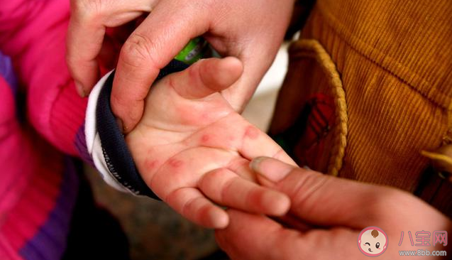 小孩發(fā)熱伴有皮疹是怎么回事 小孩發(fā)熱伴有皮疹可能是什么疾病 小孩發(fā)熱伴有皮疹是怎么回事 小孩發(fā)熱伴有皮疹可能是什么疾病