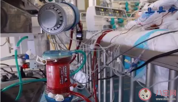 ecmo是什么意思 ecmo什么情況下用