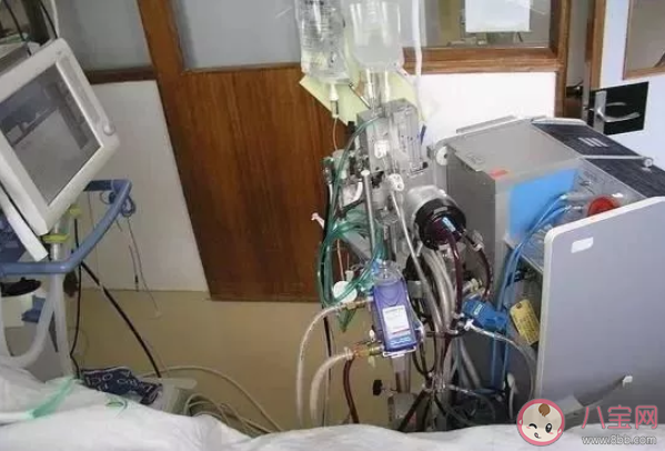 ecmo是什么樣子的 ecmo有什么用