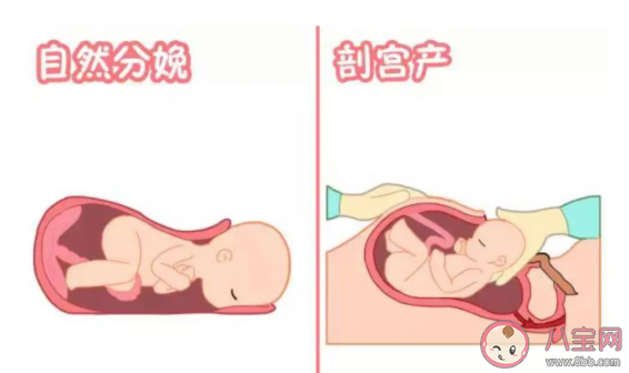 準(zhǔn)媽媽順產(chǎn)有什么好處 孕婦生孩子有有什么利弊