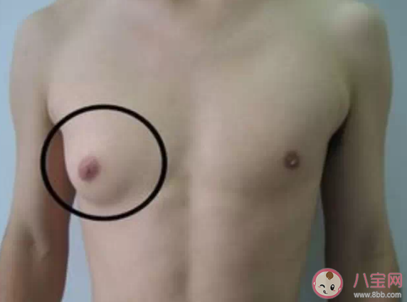 男性乳腺增生要緊嗎 男性乳腺增生能自愈嗎 男性乳腺增生要緊嗎 男性乳腺增生能自愈嗎
