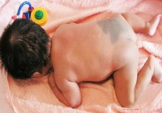 嬰兒胎記幾歲可以去除  嬰兒頭皮上有胎記可以去除嗎