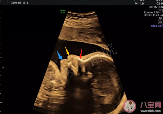 孕檢說胎兒腿短以后長不高嗎  胎寶寶腿短孕媽媽吃啥