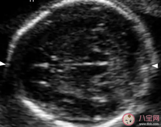 胎兒心臟有強(qiáng)光點(diǎn)要不要緊  胎兒心臟有強(qiáng)光點(diǎn)是怎么引起的