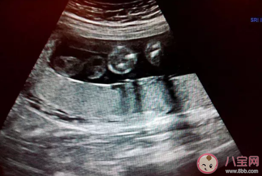 胎盤成熟慢會推遲生嗎  胎盤成熟慢是缺鈣嗎