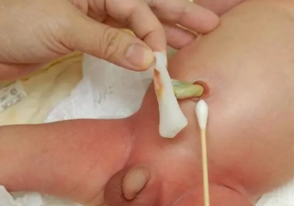 新生兒肚臍多長時間能痊愈  臍帶未脫落前能給寶寶穿紙尿褲嗎