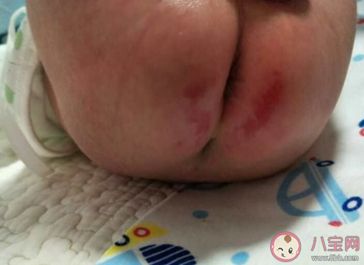 寶寶紅屁屁怎么樣能快些好 寶寶紅屁屁會哭鬧嗎 寶寶紅屁屁怎么樣能快些好 寶寶紅屁屁會哭鬧嗎