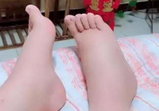 孕期腿腫和血糖有關(guān)系嗎  腿腫一按一個坑怎么辦是不是糖尿病