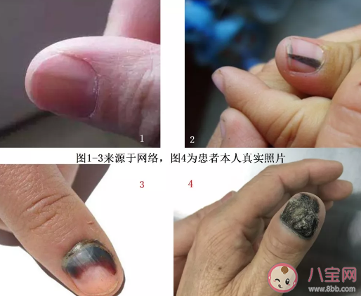 小孩指甲根發黑怎么回事 小孩指甲發黑什么 小孩指甲根發黑怎么回事 小孩指甲發黑什么