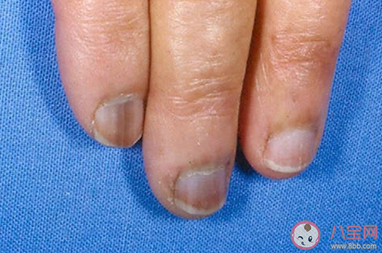 小孩指甲根發黑怎么回事 小孩指甲發黑什么 小孩指甲根發黑怎么回事 小孩指甲發黑什么