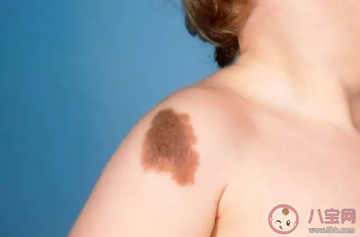 孕肚子受到撞擊會留下胎記嗎  寶寶有胎記懷孕時能檢查出來嗎