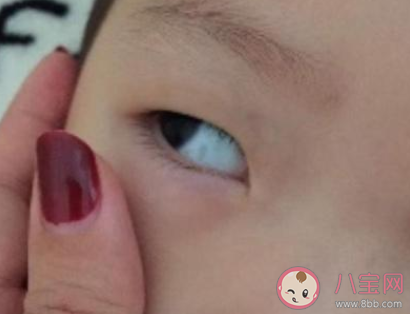 寶寶眼睛有黑點是怎么回事 眼睛有黑點漂浮物怎么治療 寶寶眼睛有黑點是怎么回事 眼睛有黑點漂浮物怎么治療