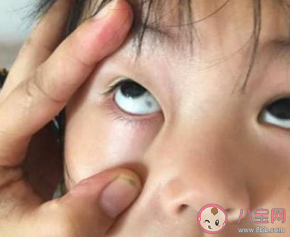 寶寶眼睛有黑點是怎么回事 眼睛有黑點漂浮物怎么治療 寶寶眼睛有黑點是怎么回事 眼睛有黑點漂浮物怎么治療