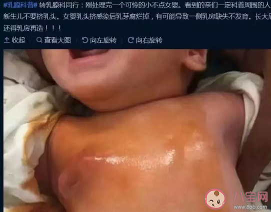 寶寶剛生出來就擠乳頭好嗎 新生女寶要不要擠乳頭 寶寶剛生出來就擠乳頭好嗎 新生女寶要不要擠乳頭
