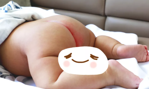 夏季孩子容易紅屁股怎么回事 孩子紅屁屁怎么護理