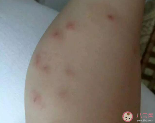 可以給寶寶使用花露水或風油精嗎 寶寶被蚊子叮咬怎么護理好 