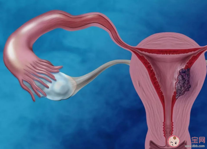子宮衰老有什么癥狀 如何減緩子宮衰老的速度
