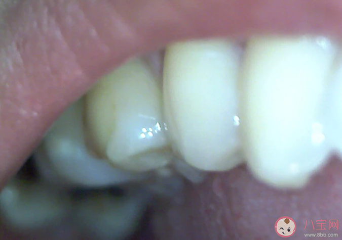 備孕期看牙科有影響嗎 備孕的時(shí)候智齒要拔掉嗎