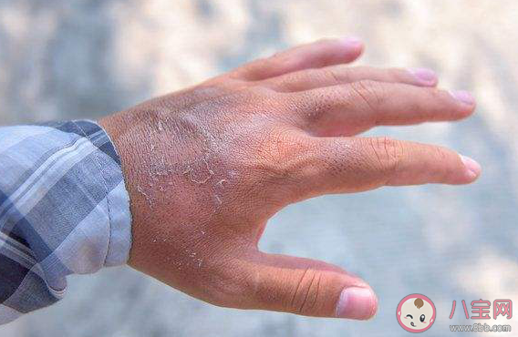 孕期手脫皮是不是血熱造成的 孕婦血熱引起的手脫皮如何解決 孕期手脫皮是不是血熱造成的 孕婦血熱引起的手脫皮如何解決