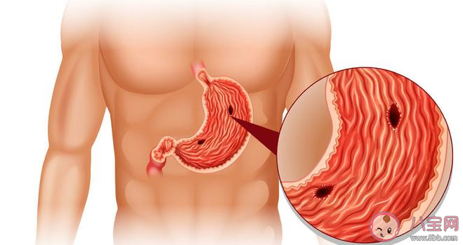 接吻會感染幽門螺旋桿菌嗎 怎么知道是不是有幽門螺旋桿菌 接吻會感染幽門螺旋桿菌嗎 怎么知道是不是有幽門螺旋桿菌