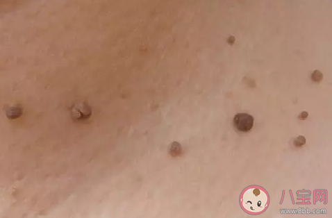 脖子是上有小肉粒是什么 脖子上長(zhǎng)小肉疣怎么去除 脖子是上有小肉粒是什么 脖子上長(zhǎng)小肉疣怎么去除