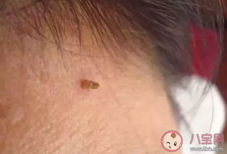 脖子是上有小肉粒是什么 脖子上長(zhǎng)小肉疣怎么去除 脖子是上有小肉粒是什么 脖子上長(zhǎng)小肉疣怎么去除