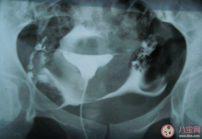 輸卵管粘連還能自然受孕嗎 輸卵管粘連怎么治療最有效 輸卵管粘連還能自然受孕嗎 輸卵管粘連怎么治療最有效